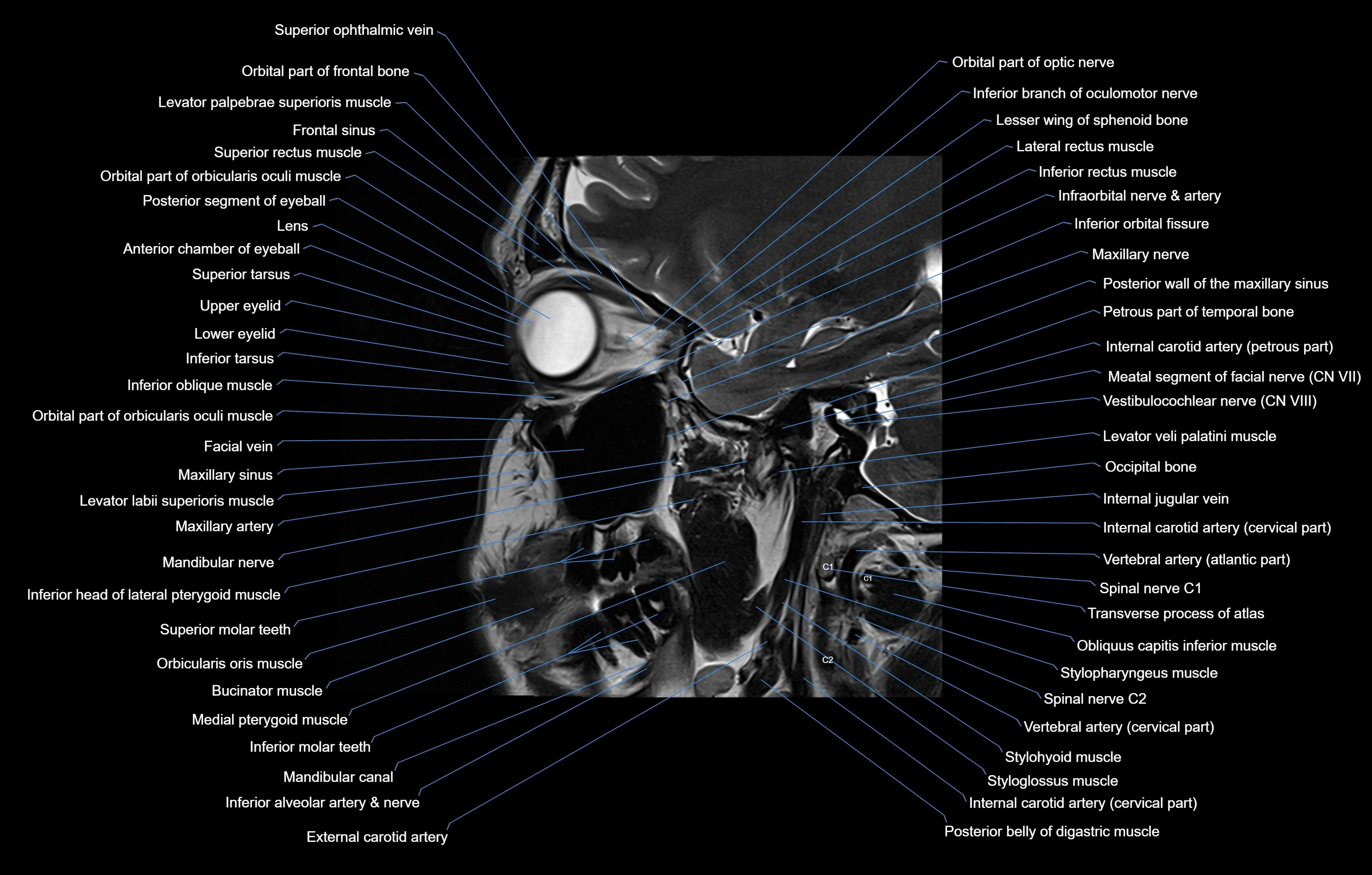 paranasal sinuses(PNS) MRI coronal  cross sectional anatomy 3T radiology  image-img-00001-00012.webp